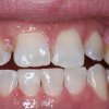 Lower Chipped Tooth After